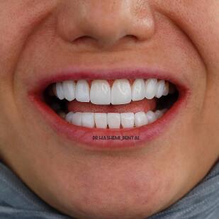 لمینت دندان