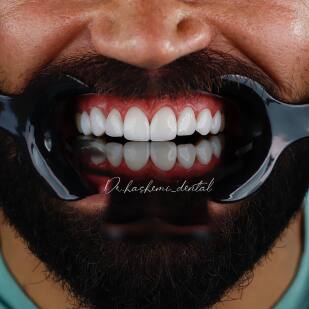 اصلاح طرح لبخند