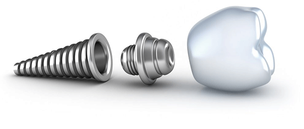 مراحل کاشت انواع مختلف ایمپلنت