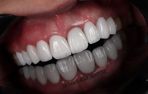 آشنایی با کامپوزیت