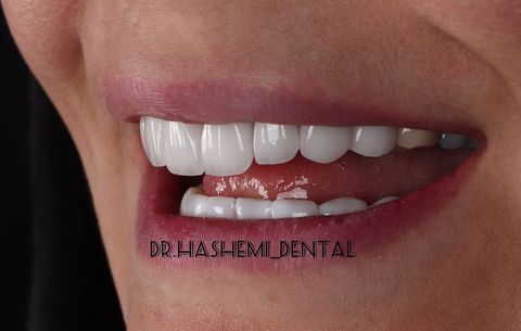 مشاوره قبل از درمان های دندانپزشکی زیبایی