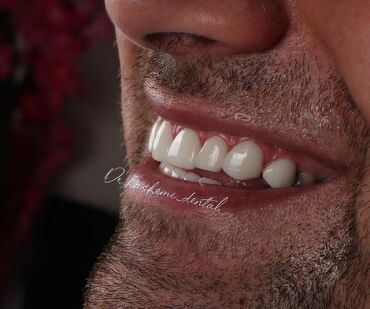 کامپوزیت ونیر