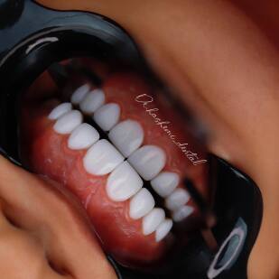 بلچینگ دندان